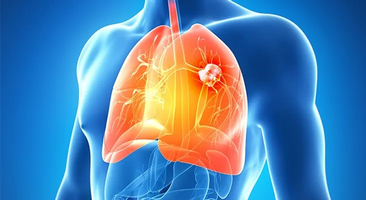 Te sorprenderá al ver que causa el cáncer de pulmón