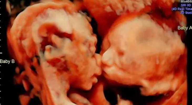 FOTO VIRAL: Ecografía capta a gemelas dándose un tierno beso en el vientre materno