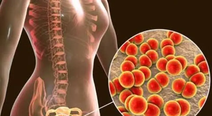 La gonorrea puede infectar a hombres y mujeres; causas, síntomas y consecuencias