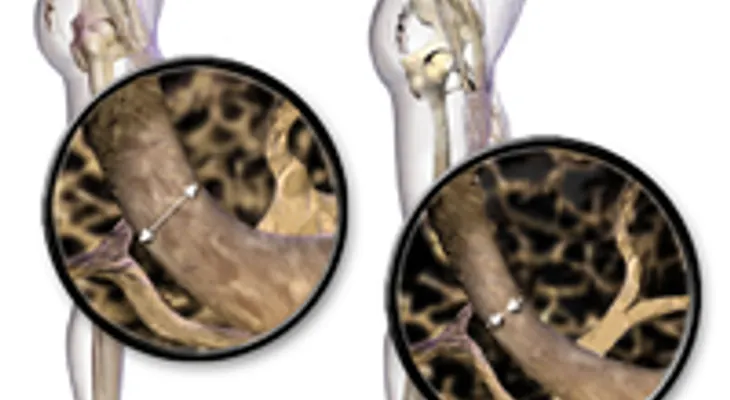 Enfermedades reumáticas y osteoporosis: tratamiento