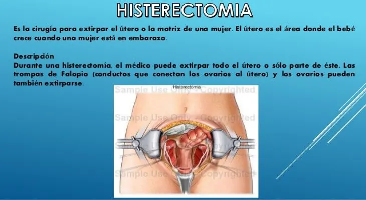 La extirpación del útero: Consejos antes y después de la intervención 