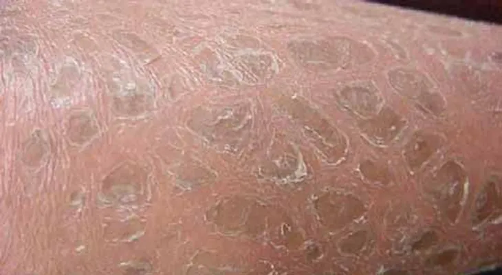  Ictiosis: nacer con una piel especial similar a las escamas de un pez 