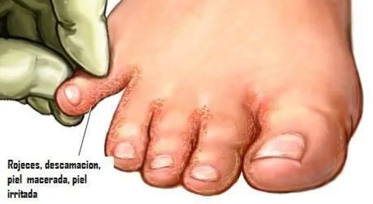 Tratamiento para hongos en las uñas o pie de atleta