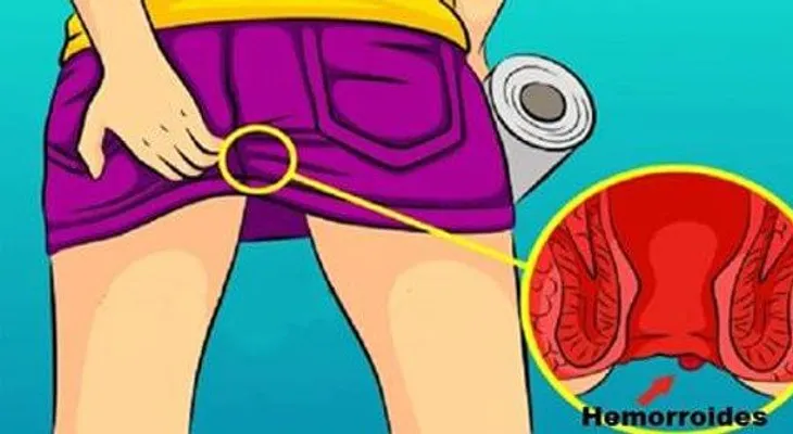 Dile adiós a las hemorroides por completo con estos remedios naturales 