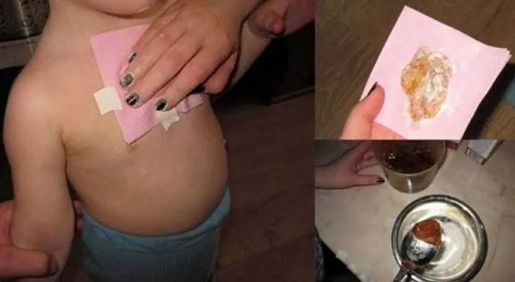 Con envoltura de jengibre y miel: Combatí mi tos y la mucosidad de mis pulmones en una sola noche