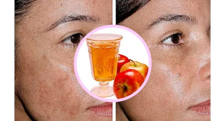 Coloca vinagre de manzana en tu cara y desparecerán tus manchas de la edad y toxinas 
