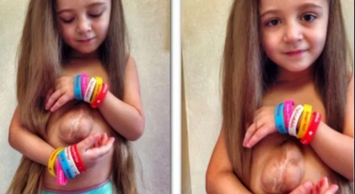Virsaviya, la niña que nació con el corazón por fuera del pecho
