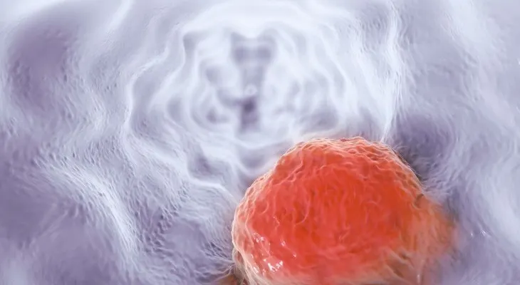 Un medicamento (fostamatinib) que ya está en venta, evitaría la propagación del cáncer