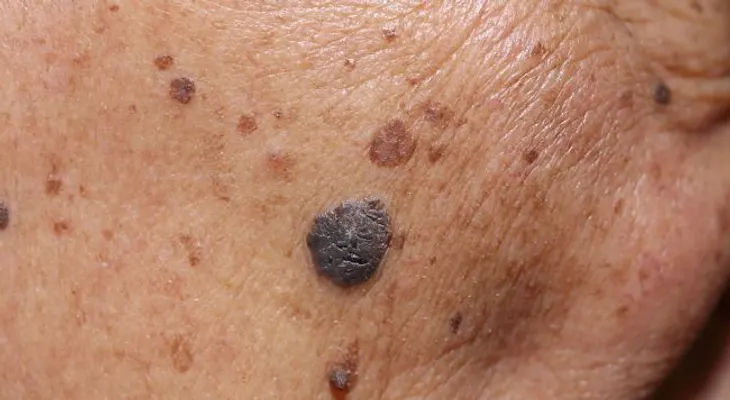 5 maneras de prevenir el cáncer de piel