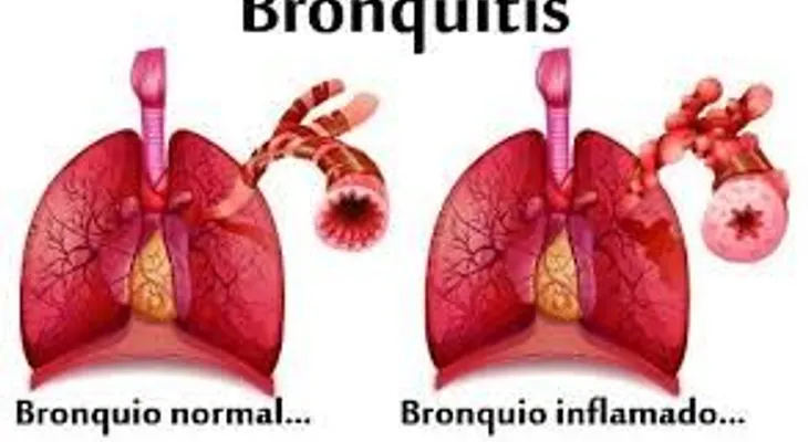 La bronquitis y los remedios para tratarla