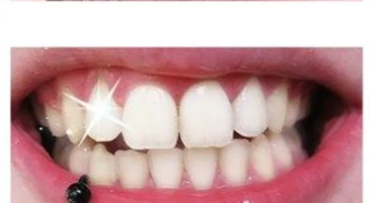 ¿Te cepillaría con carbón; una tendencia que según especialistas puede dañar los dientes 