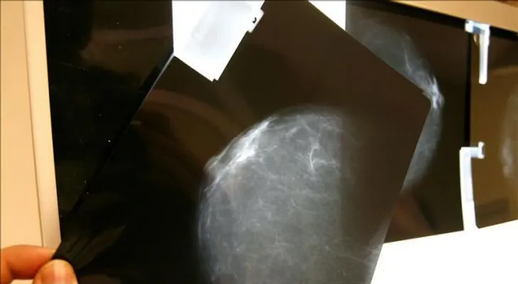 Algunas mujeres, largas supervivientes del cáncer de mama HER2  
