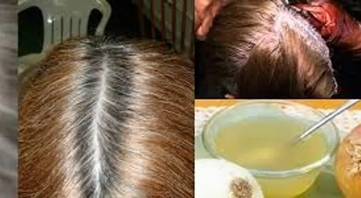 Este jugo de cebolla elimina todas las canas de tu cabeza