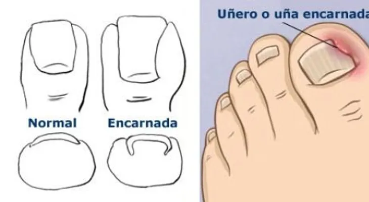 4 Tips uñas enterradas