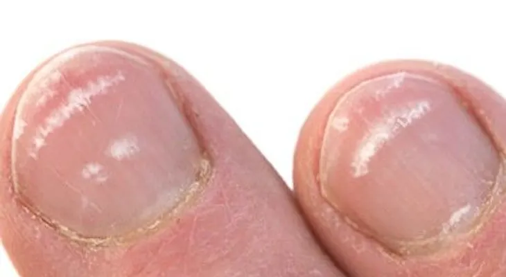 ¿Quieres saber por qué aparecen esas manchas blancas en las uñas? ¡Te ASOMBRARÁS!
