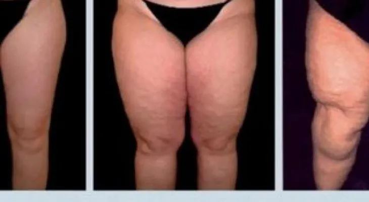 Lipedema, una dura enfermedad que debes conocer