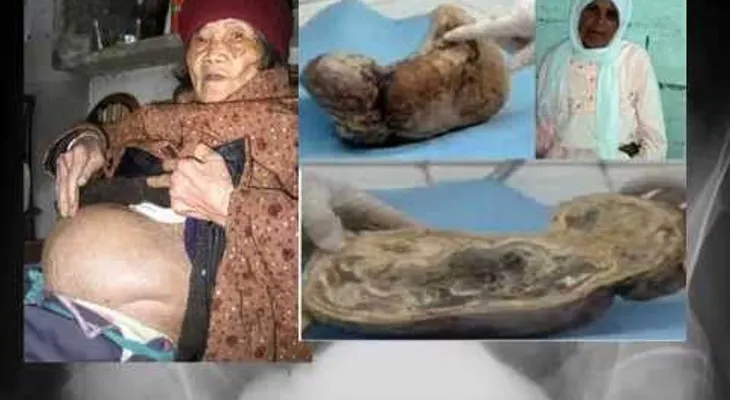 Hallan feto de 44 años en una mujer de 84