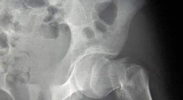Niveles adecuados de magnesio evitan las fracturas óseas en los mayores