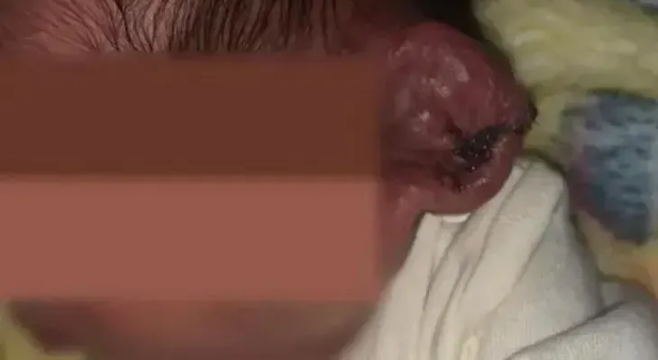 Médicos cortan oreja de recién nacido en una cesárea con la luz de tres celulares
