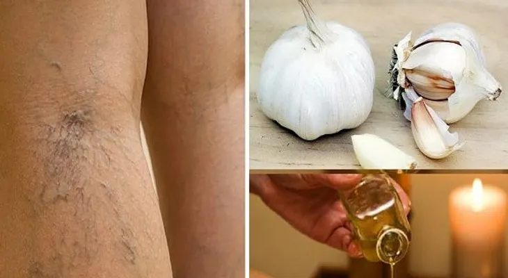 Dile adiós a las várices de las piernas naturalmente