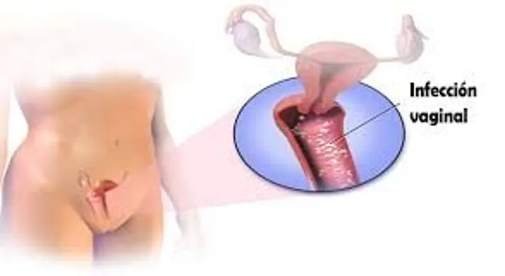 Remedios naturales para la vagina hinchada