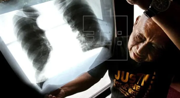 Diagnóstico tardío causa daños cerebrales a pacientes con cáncer de pulmón