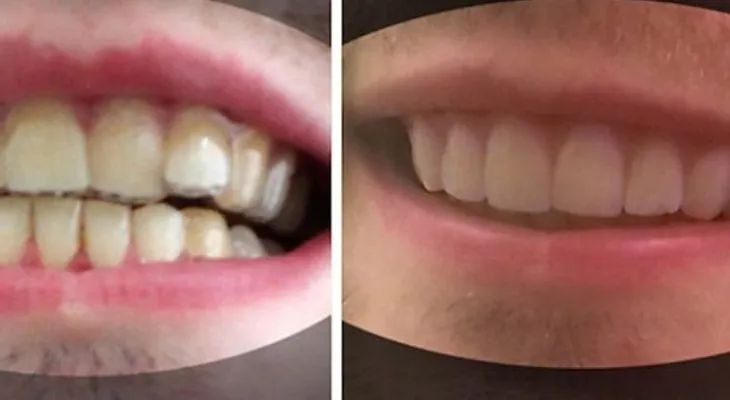 Lo que este chico hizo con sus dientes, le ahorró miles de dólares. ¡Una idea perfecta!
