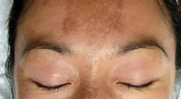Factores que inciden en la enfermedad de melasma 