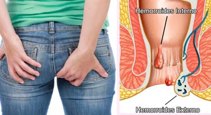 Esta receta que cura la hemorroides en 20 minutos tiene asombrados a los médicos