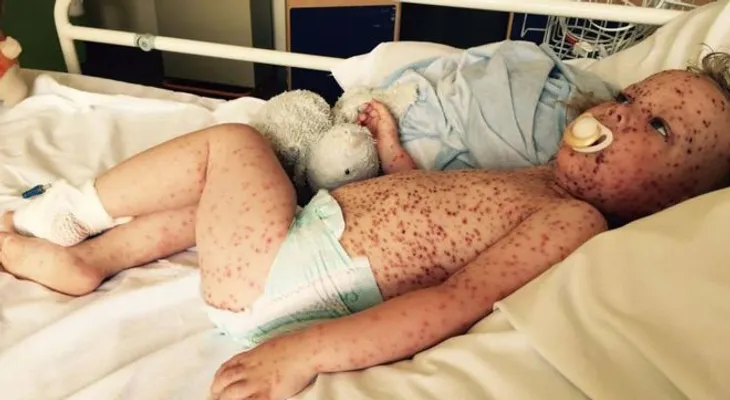 Este niño sufre del peor caso de varicela