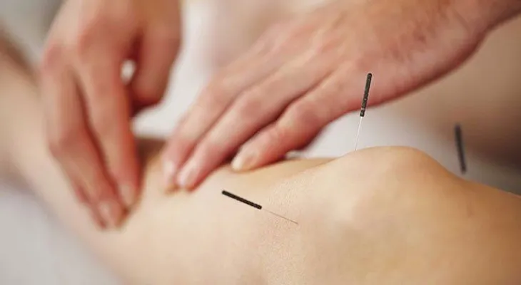 Esto pasa con tu cuerpo cuando usas la acupuntura