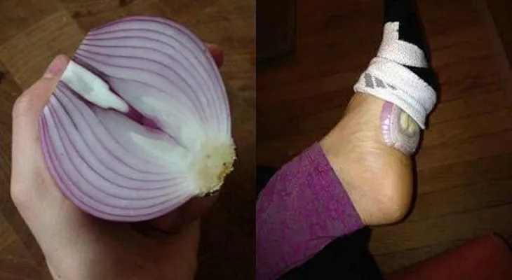 Cebollas en los pies para desintoxicar y curar gripe e infecciones ¿funciona?