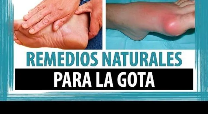 Anótalo estos 5 remedios naturales para combatir la gota 