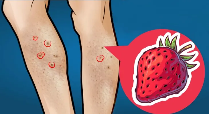 Piernas de fresa: causas y remedios caseros para deshacerte de ellas