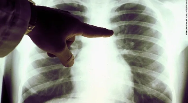 Investigadores cubanos luchan contra el cáncer de pulmón con una vacuna