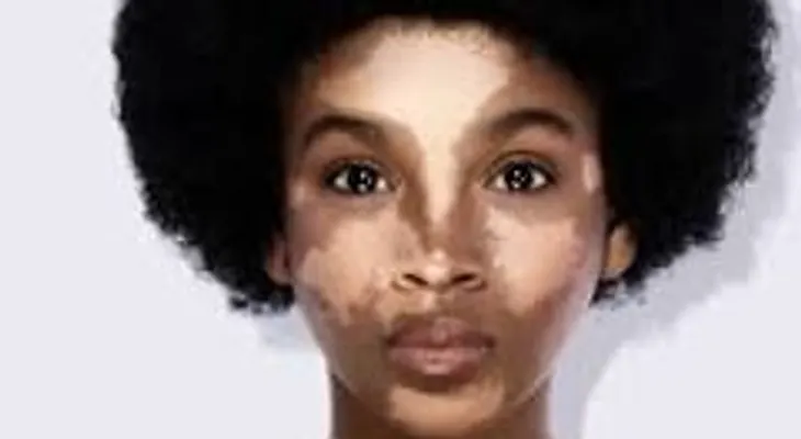 Vitiligo nunca MÁS. Nunca MÁS 