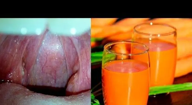 5 remedios caseros para las Amigdalas; como desinflamar las Anginas