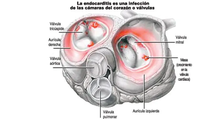Endocarditis; causa, síntoma y prevención   (VIDEO)