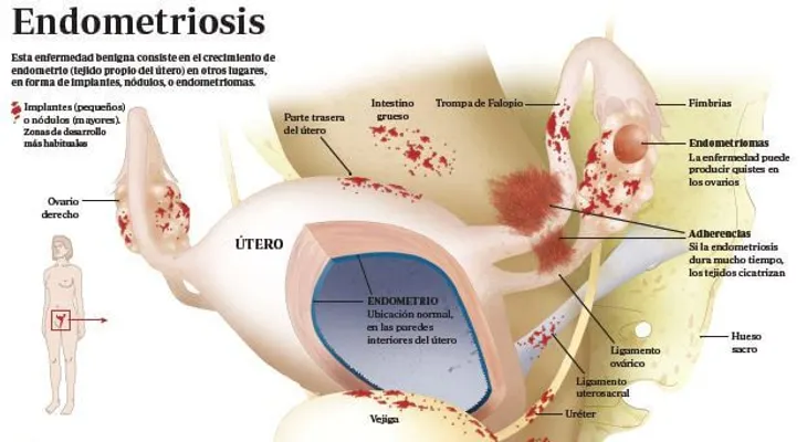 Endometriosis: Lo que no te explican y necesita saber (VIDEO)