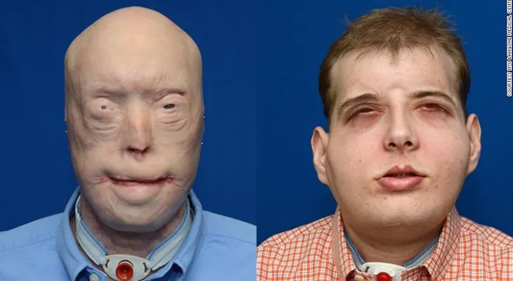 Este hombre recibió el transplante de cara más extenso de la historia