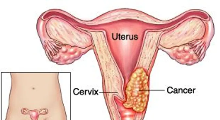 Cáncer de cuello uterino se asocia con la infección de VPH y es prevenible
