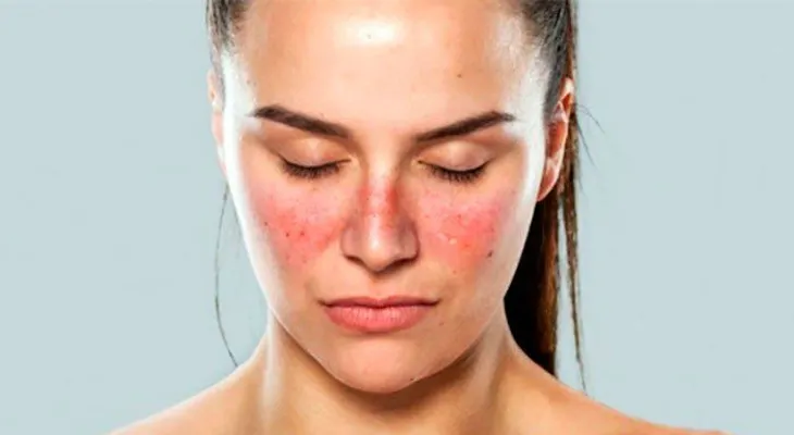 El lupus: 11 signos de que puedes estar padeciendo de esta enfermedad