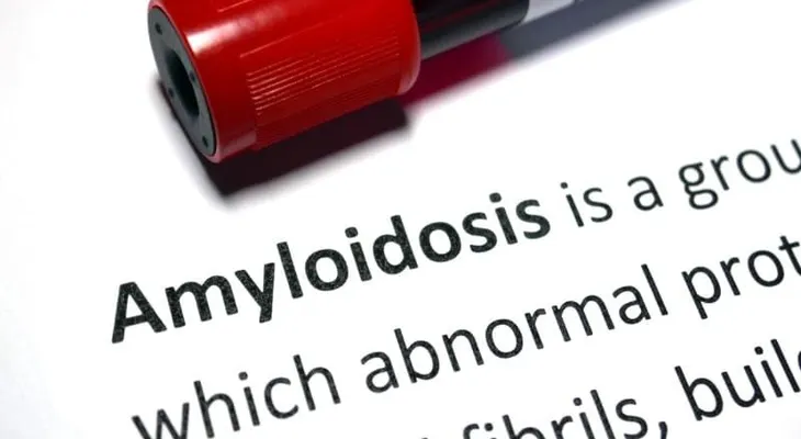 La amiloidosis sistémica (AS) es un trastorno de las proteínas que conduce a la disfunción orgánica
