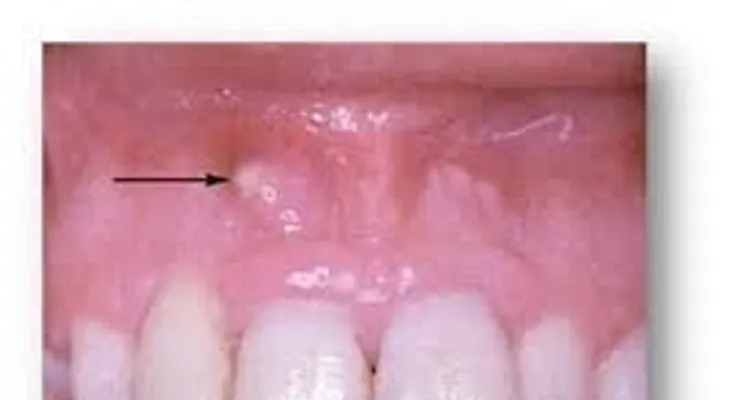  Osteomielitis (infección dental) afecta a 50 por ciento niños y puede dejar graves secuelas 
