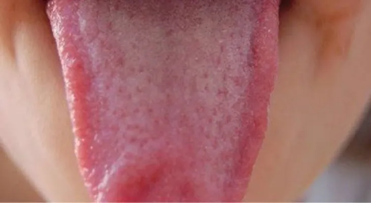 Ponle atención a tu lengua: 9 cosas que intenta decirte sobre tu salud
