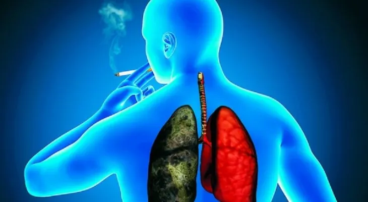 Revelan cáncer de pulmón es el que causa más muertes a nivel mundial