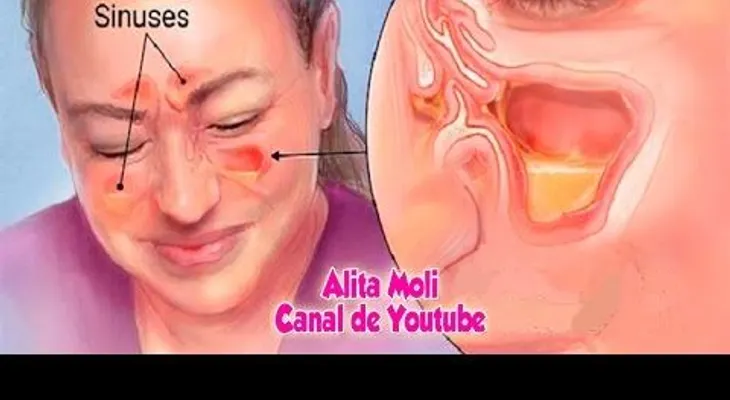 Un remedio que mata la infección de la sinusitis en 20 segundos 