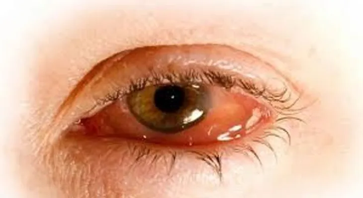 5 errores comunes que irritan los ojos