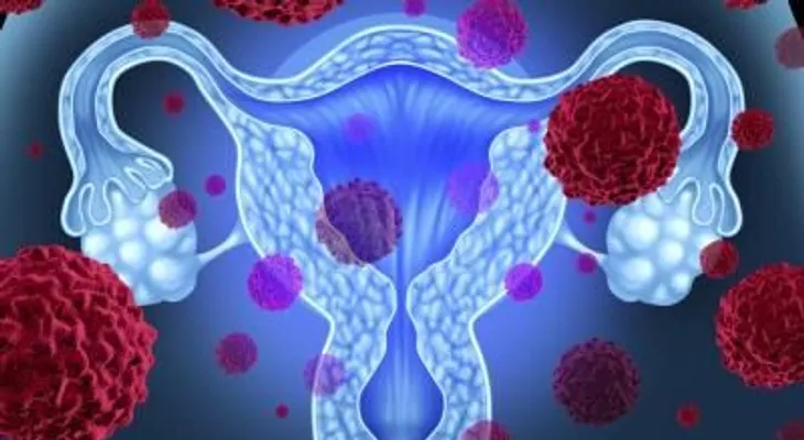 Una menstruación irregular aumenta el riesgo de cáncer de ovario