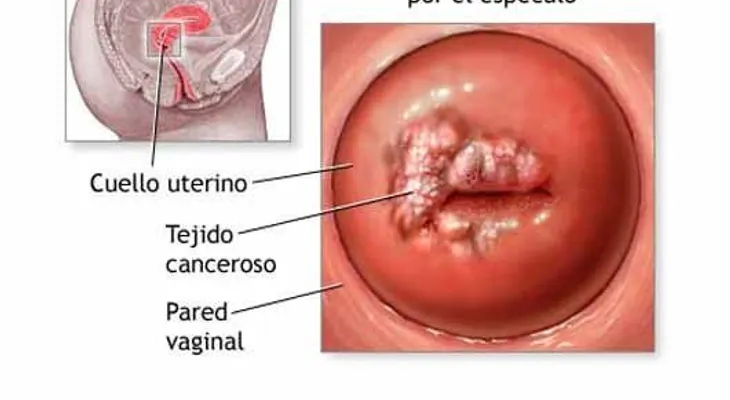 12 señales de cáncer cervical que toda mujer necesita saber